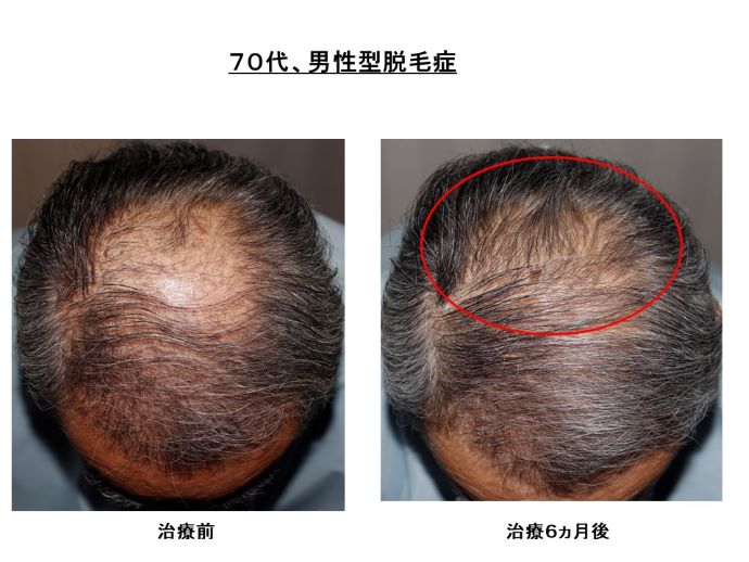 円形脱毛症　病院